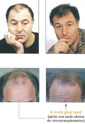 La micro transplantation ou microgreffes capillaires -  - ESTHETICAP - Centre d'Expertise Capillaire