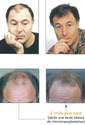La micro transplantation ou microgreffes capillaires