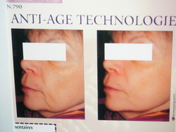 lifting ultrasonic - Institut de beaut Krystyna